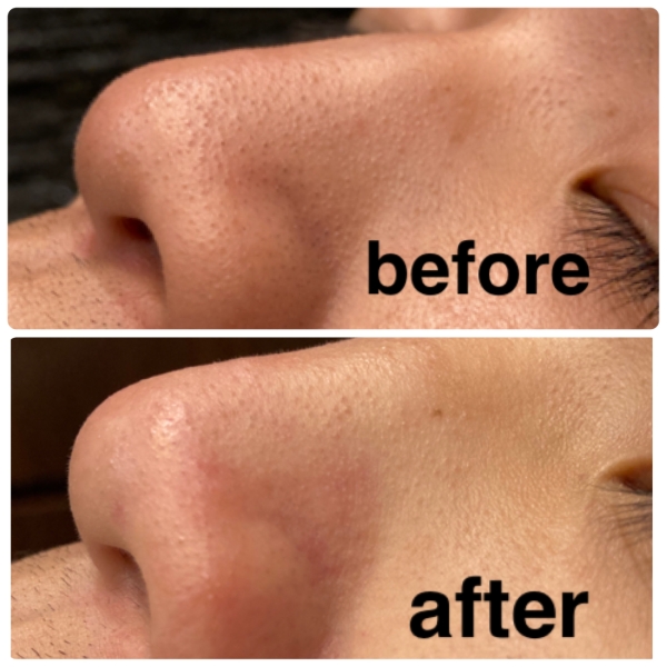 Concerned About Clogged Pores Around Your Nose?